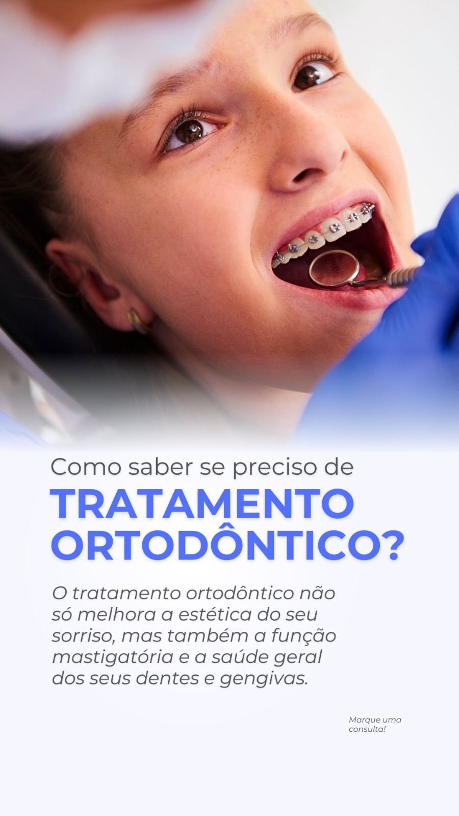 Descubra se Você Precisa de Tratamento Ortodôntico Antes de iniciar qualquer tratamento, um ortodontista realizará uma avaliação detalhada, que inclui exame clínico, réplicas em gesso dos seus dentes, radiografias e fotografias. Com base nesses exames, o especialista poderá diagnosticar corretamente e sugerir o plano de tratamento mais adequado para você. 💡 Sinais de que você pode precisar de tratamento ortodôntico: Mordida Cruzada: Quando os dentes superiores se encaixam atrás dos inferiores, indicando uma relação inadequada entre maxilar superior e inferior. Mordida Aberta: Caracteriza-se pela incapacidade de fechar completamente os dentes anteriores ou posteriores, resultando em um espaço entre as arcadas quando a boca está fechada. Sobremordida: Ocorre quando os dentes superiores cobrem excessivamente os dentes inferiores. Mordida Inferior (Prognatismo): Esta situação acontece quando os dentes inferiores se projetam além dos dentes superiores, indicando um desalinhamento significativo. Linha Média Deslocada: Se a linha central dos dentes superiores não coincide com a dos inferiores, isso pode indicar um problema de alinhamento. Espaçamento: Gaps ou espaços entre os dentes podem ser decorrentes de dentes que não ocupam totalmente o espaço disponível ou de dentes que faltam. Apinhamento: Isso acontece quando não há espaço suficiente na mandíbula para todos os dentes, o que pode causar sobreposição e torção dentária. 🌟 Agende sua consulta hoje mesmo e dê o primeiro passo para conquistar o sorriso dos seus sonhos! #TratamentoOrtodontico #SaudeBucal #Ortodontia