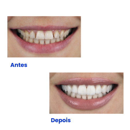 Clínica dentista em santo amaro que coloca lente nos dentes