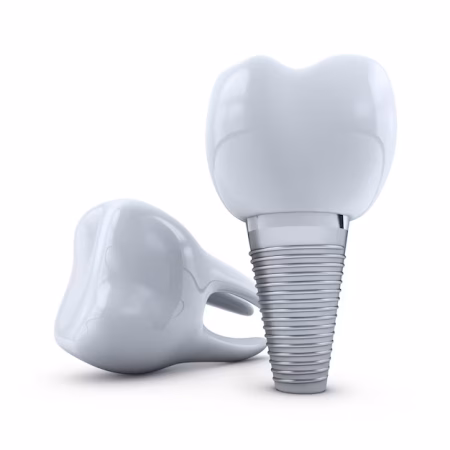 Implente dentário santo amaro
